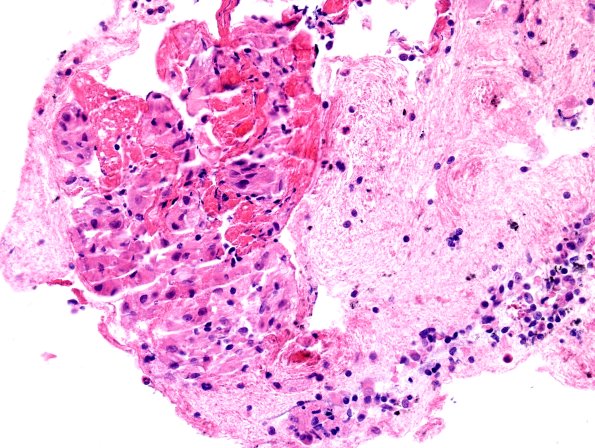 2C2 Sarcoid & Chronic Denervation - lung FNA (Case 2).jpg