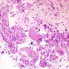 2C3 Sarcoid & Chronic Denervation - lung FNA Case 2) AFB.jpg