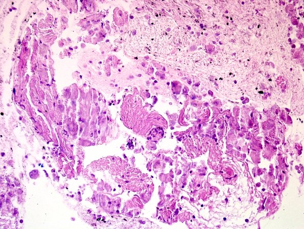 2C3 Sarcoid & Chronic Denervation - lung FNA Case 2) AFB.jpg