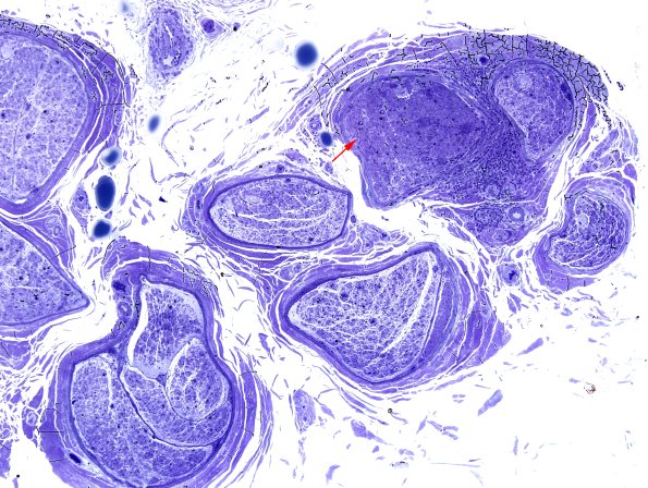 2D1 Sarcoid & Chronic Denervation (Case 2) Plastic 2 copy.jpg