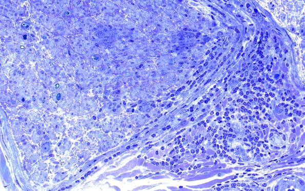 2D4 sarcoid & Chronic Denervation (Case 2) Plastic 40X 2