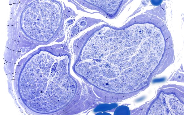 2D5 sarcoid & Chronic Denervation (Case 2) Plastic 20X 3