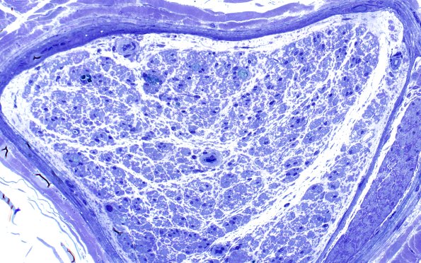 2D6 sarcoid & Chronic Denervation (Case 2) Plastic 40X 3