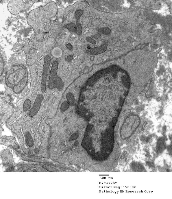 2E4 Sarcoid & Chronic Denervation (Case 2) EM 073 - Copy