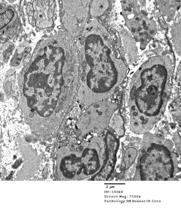 2E5 Sarcoid & Chronic Denervation (Case 2) EM 098 - Copy
