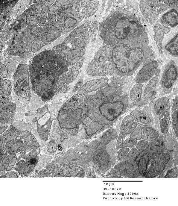 2E7 Sarcoid & Chronic Denervation (Case 2) EM 094 - Copy