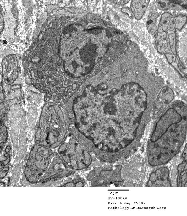 2E8 Sarcoid & Chronic Denervation (Case 2) EM 095 - Copy
