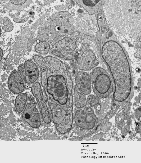 2F1 Sarcoid & Chronic Denervation (Case 2) EM 104 - Copy