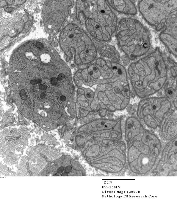 2F2 Sarcoid & Chronic Denervation (Case 2) EM 132 - Copy