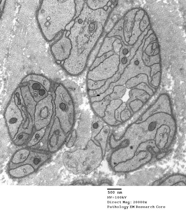 2F3 Sarcoid & Chronic Denervation (Case 2) EM 004 - Copy