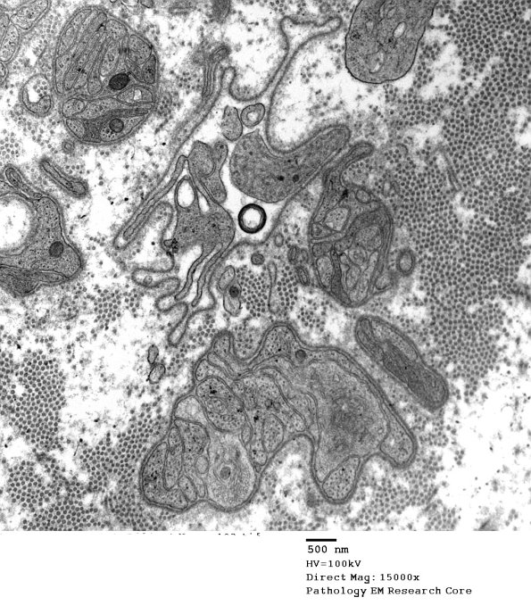2F4 Sarcoid & Chronic Denervation (Case 2) EM 123 - Copy