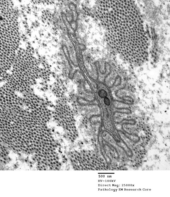 2F5 Sarcoid & Chronic Denervation (Case 2) EM 122 - Copy