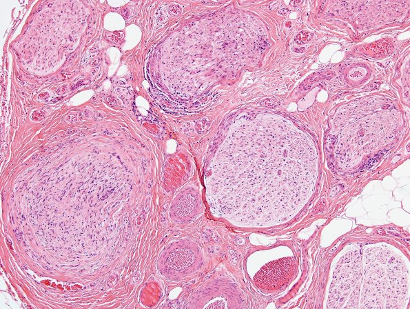 3A1 Sarcoid (Case 3) H&E 1
