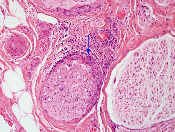 3A2 Sarcoid (Case 3) H&E 2 copy