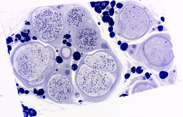 3B1 Sarcoid (Case 3) Plastic 7