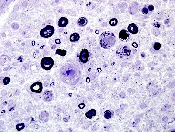 3B10 Sarcoid (Case 3) Plastic 20