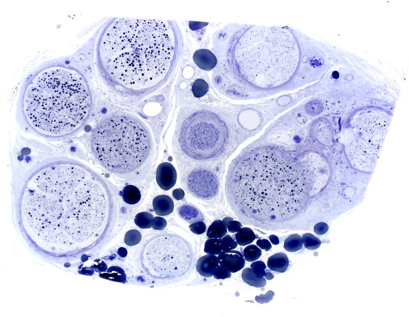 3B2 Sarcoid (Case 3) Plastic 13A