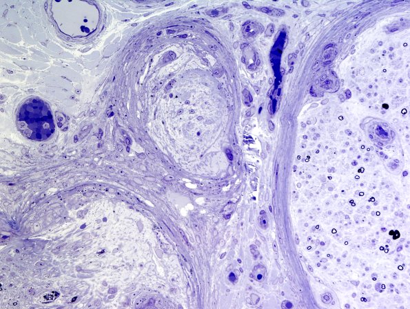3B4 Sarcoid (Case 3) Plastic 14