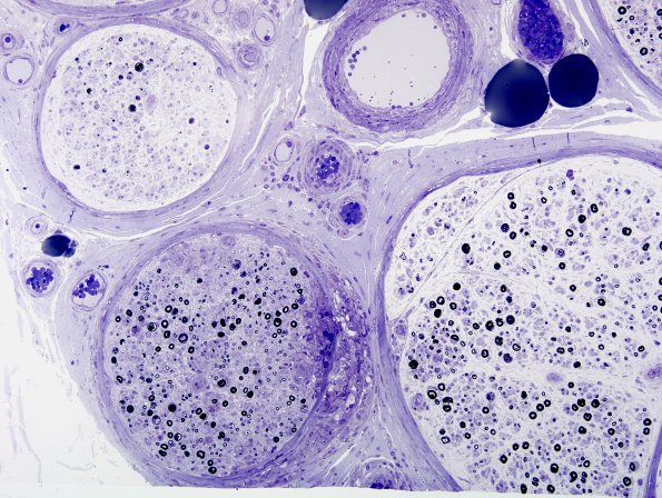 3B5A Sarcoid (Case 3) Plastic 16