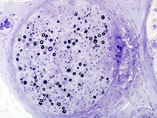 3B5B Sarcoid (Case 3) Plastic 17