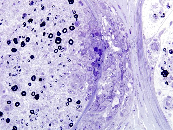 3B5C Sarcoid (Case 3) Plastic 18