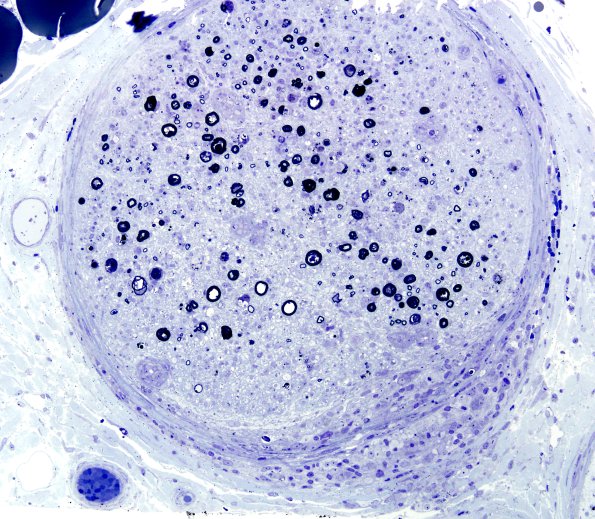 3B6A Sarcoid (Case 3) Plastic 24