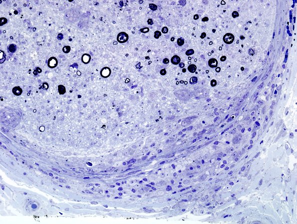 3B6B Sarcoid (Case 3) Plastic 25