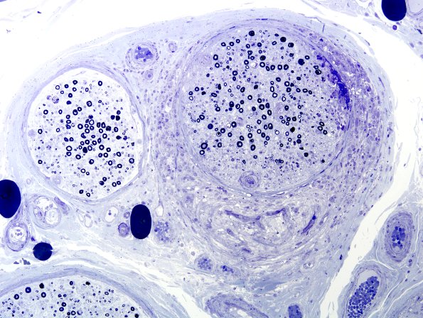 3B7 Sarcoid (Case 3) Plastic 3