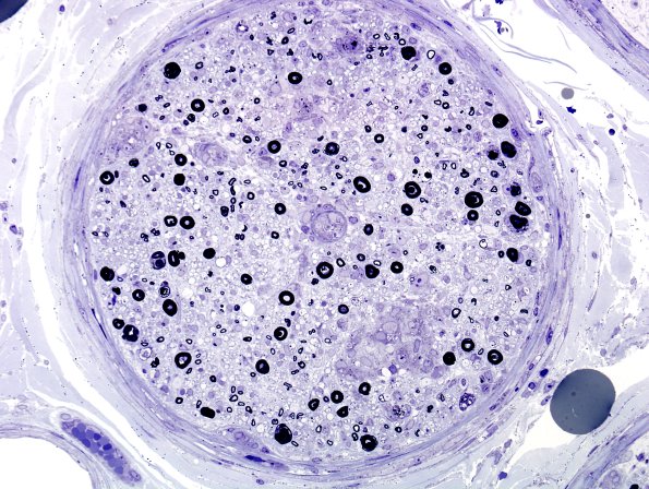 3B8A Sarcoid (Case 3) Plastic 21