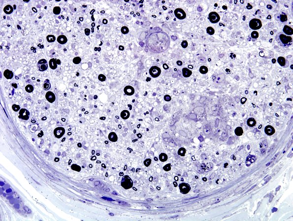 3B8B Sarcoid (Case 3) Plastic 11