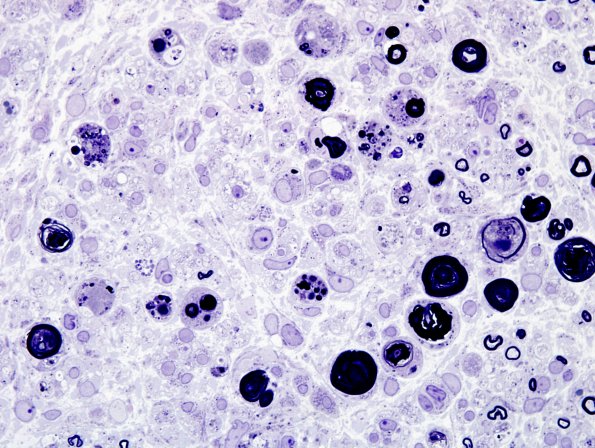 3B9 Sarcoid (Case 3) Plastic 6