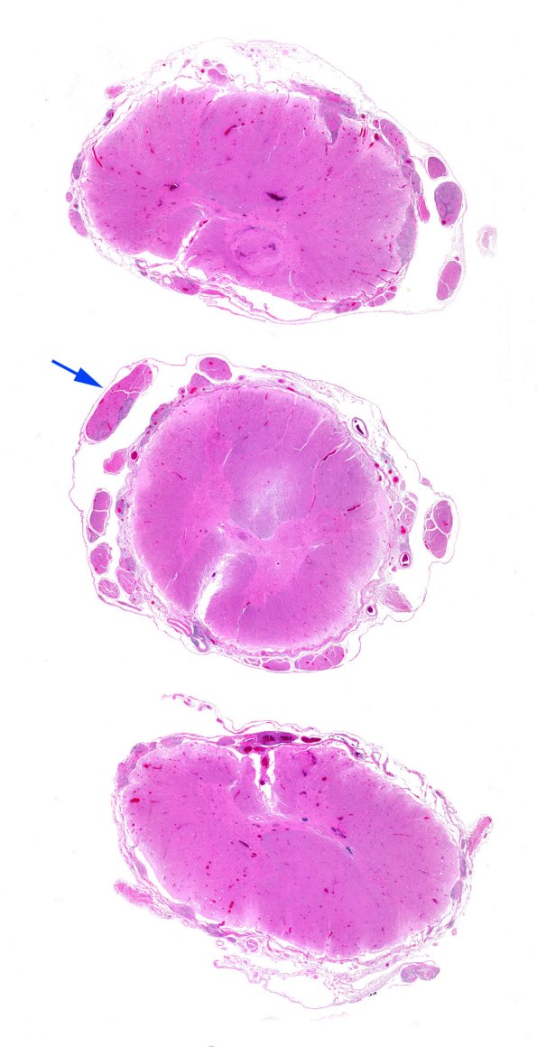 4B1 Sarcoid (Case 4) WM H&E copy