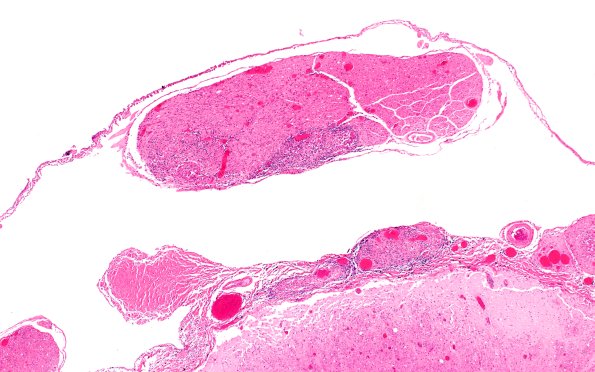 4B2 Neurosarcoid NP (Case 4) H&E 4X (2)