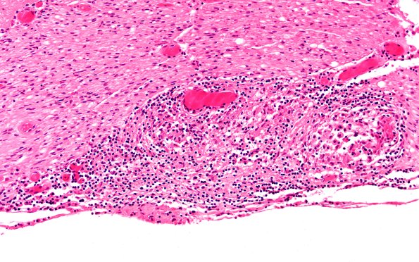 4B3 Neurosarcoid NP (Case 4) H&E 20X