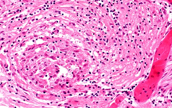 4B4 Neurosarcoid NP (Case 4) H&E 40X
