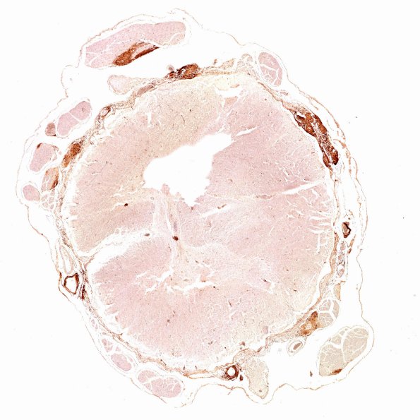 4C1 Neurosarcoid NP (Case 4) CD45 WM 2