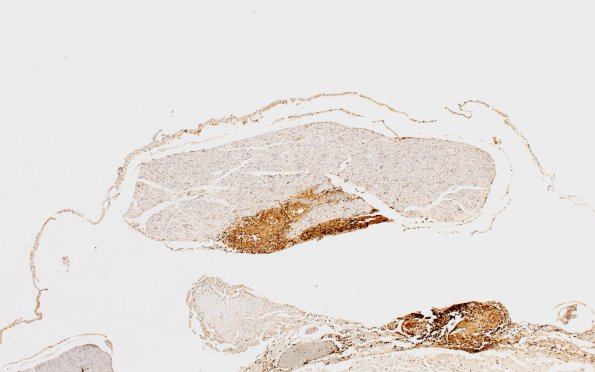 4C2 Neurosarcoid NP (Case 4) CD45 4X