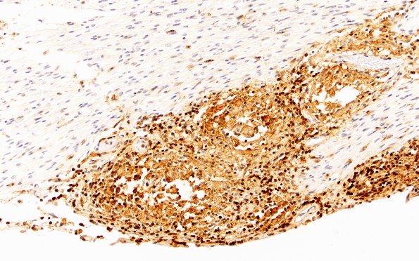 4C3 Neurosarcoid NP (Case 4) CD45 20X