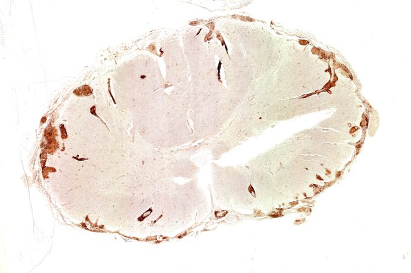 4C4 Neurosarcoid NP (Case 4) CD45 WM 1