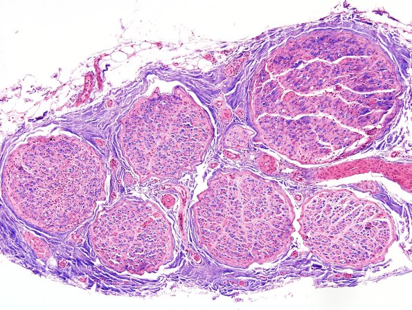 5A1 Sarcoid NP (Case 5) LFB-H&E 4.jpg