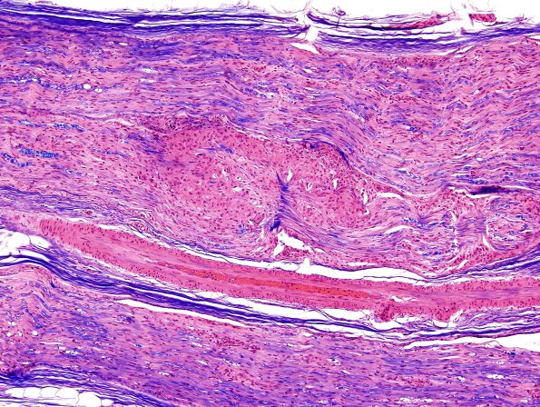 5A2 Sarcoid NP (Case 5) LFB-H&E 1.jpg
