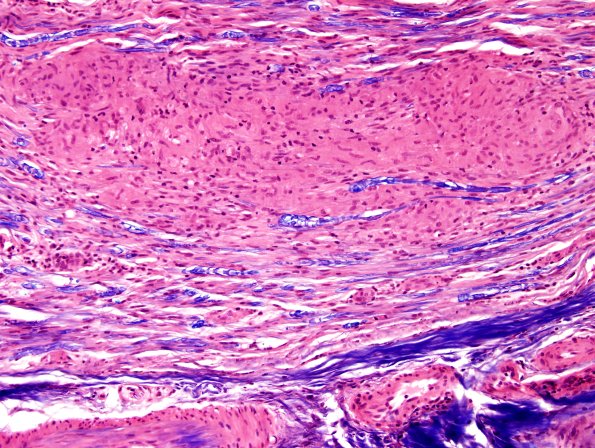 5A3 Sarcoid NP (Case 5) LFB-H&E 2.jpg