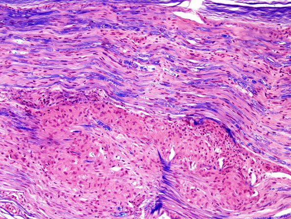 5A4 Sarcoid NP (Case 5) LFB-H&E 3.jpg