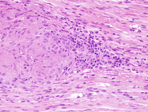 5A5 Sarcoid NP (Case 5) H&E 1