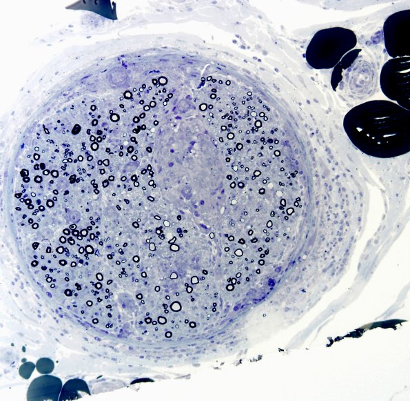 5B1 Sarcoid (Case 5) Plastic 1