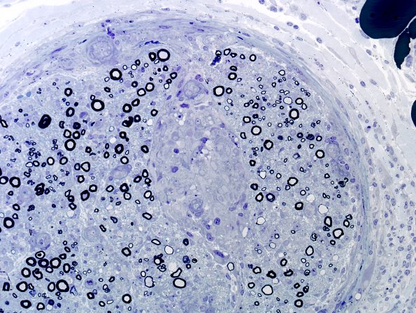 5B2 Sarcoid (Case 5) Plastic 2