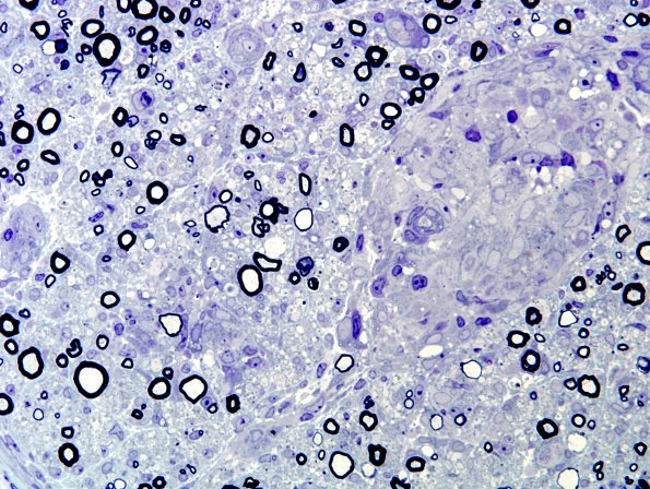 5B3 Sarcoid (Case 5) Plastic 3