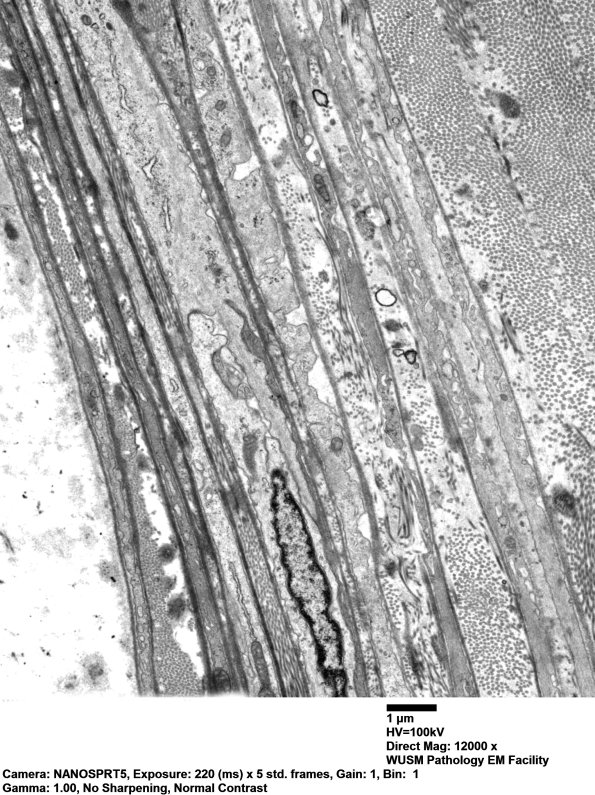 0A2 W18-10990 (Case 0) Nerve_052 - Copy - Copy