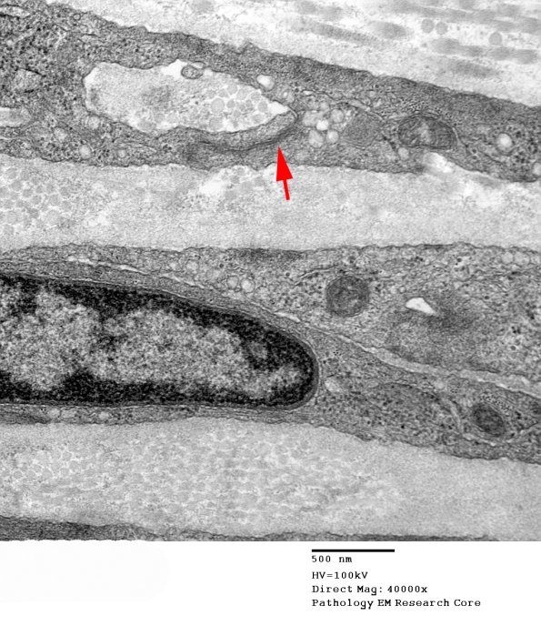 0A3 Perineurium, tight junction (Case 0) EM 005 - Copy copy