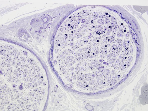 10A1 Perineurial calcifications (Case 10) Plastic 1